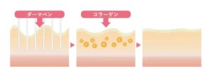 ダーマペンとは？