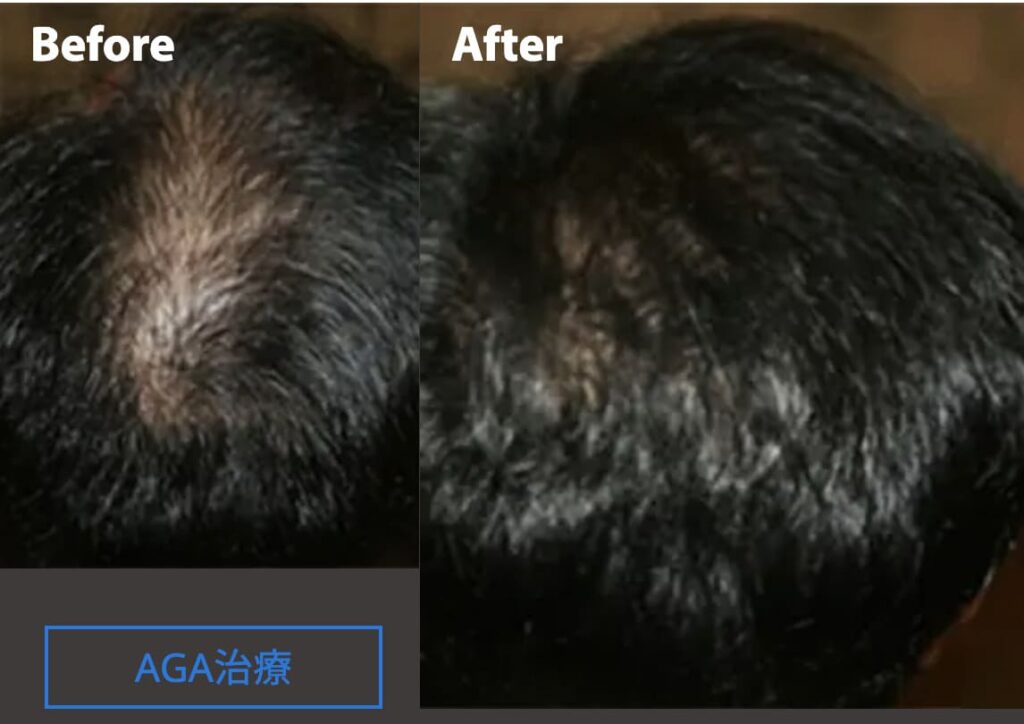 ゴリラクリニックのAGA治療を実際に受けた方の症例画像（ビフォーアフター）