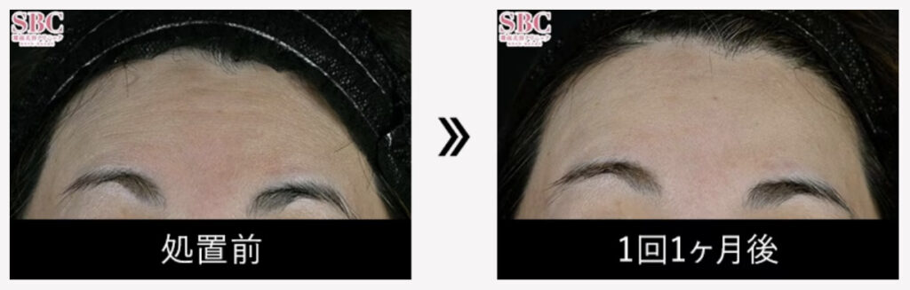湘南美容外科の女優注射を実際に受けた方の額の症例画像（ビフォーアフター）