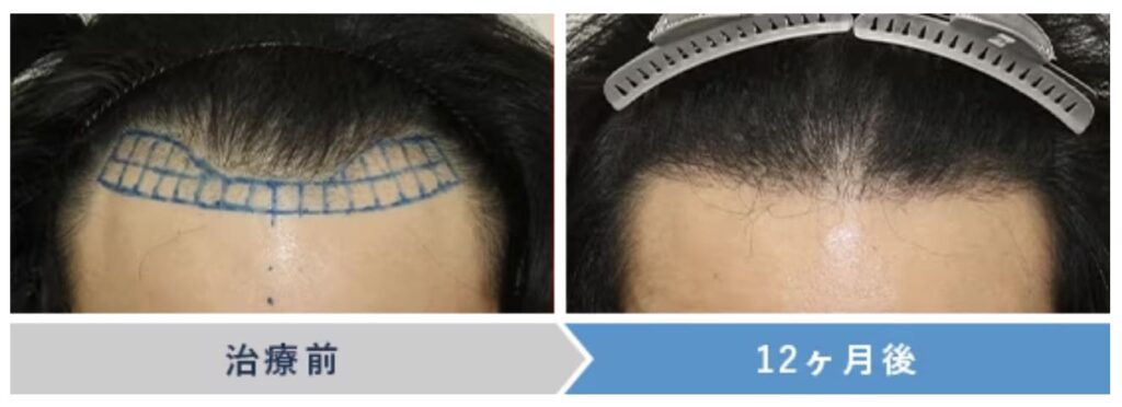 【湘南美容外科のAGA治療】自毛植毛を受けた方の症例画像（ビフォーアフター）
