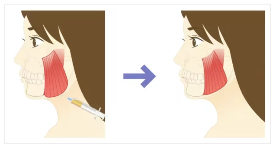 湘南美容外科の口角ボトックスの施術方法