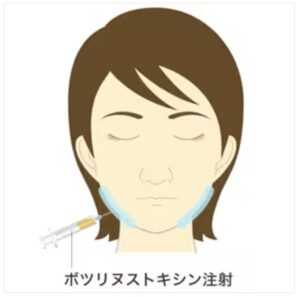 ボトックス注射とは？どのような効果があるのか解説