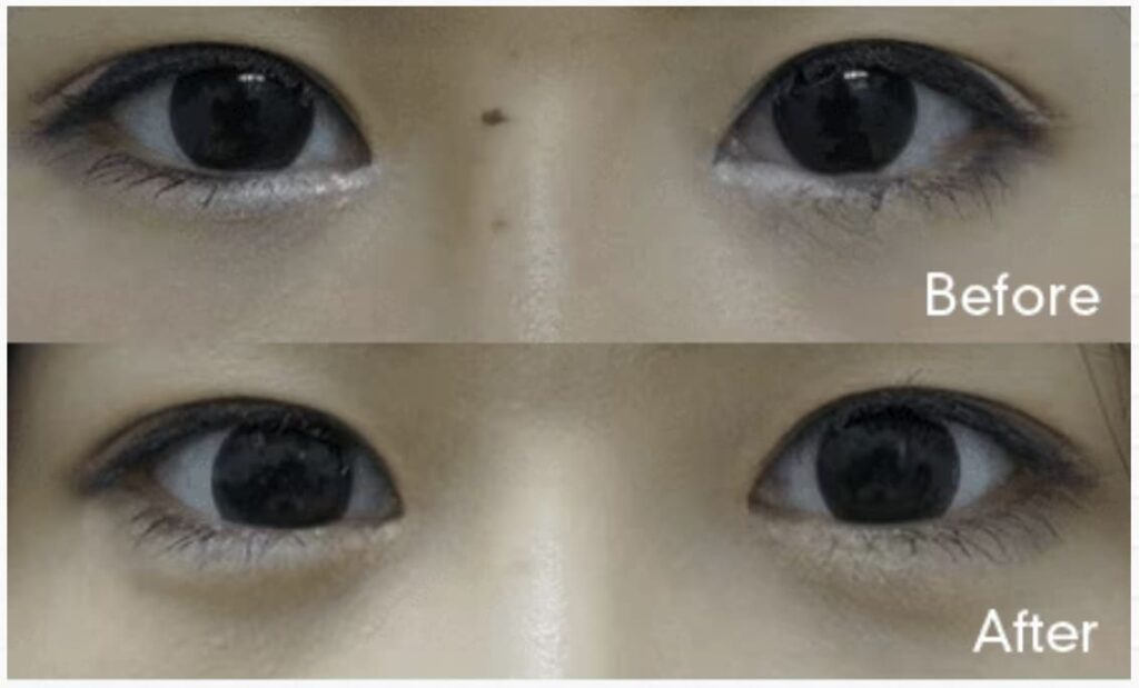 湘南美容外科の涙袋形成を実際に受けた方の症例画像（ビフォーアフター）