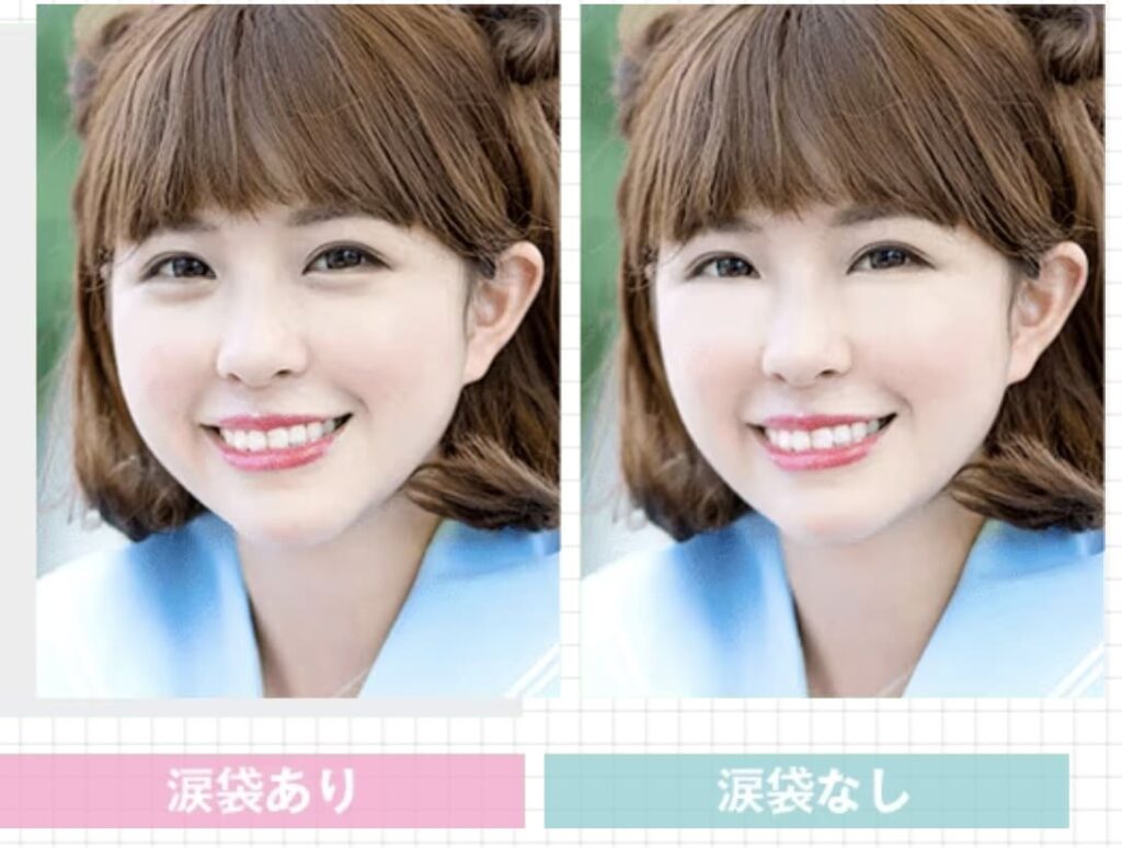TCB東京中央美容外科の涙袋形成を受けるメリットや効果
