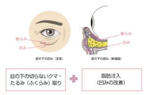 湘南美容外科の目の下の切らないクマ・たるみ取りと脂肪注入（コンフィデンスリッチ）