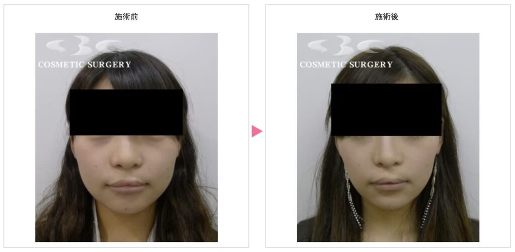 湘南美容外科で韓国製ボツリヌストキシンを受けた方の実際の症例画像（ビフォーアフター）