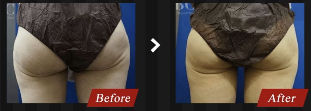 湘南美容外科の脂肪吸引、エンブレイスRFを受けた方の症例画像（ビフォーアフター）