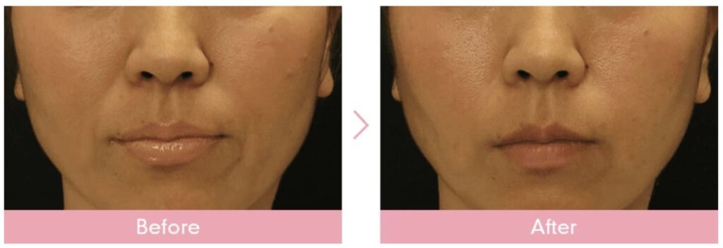 湘南美容外科のほうれい線ヒアルロン酸を実際に受けた方の症例画像（ビフォーアフター）