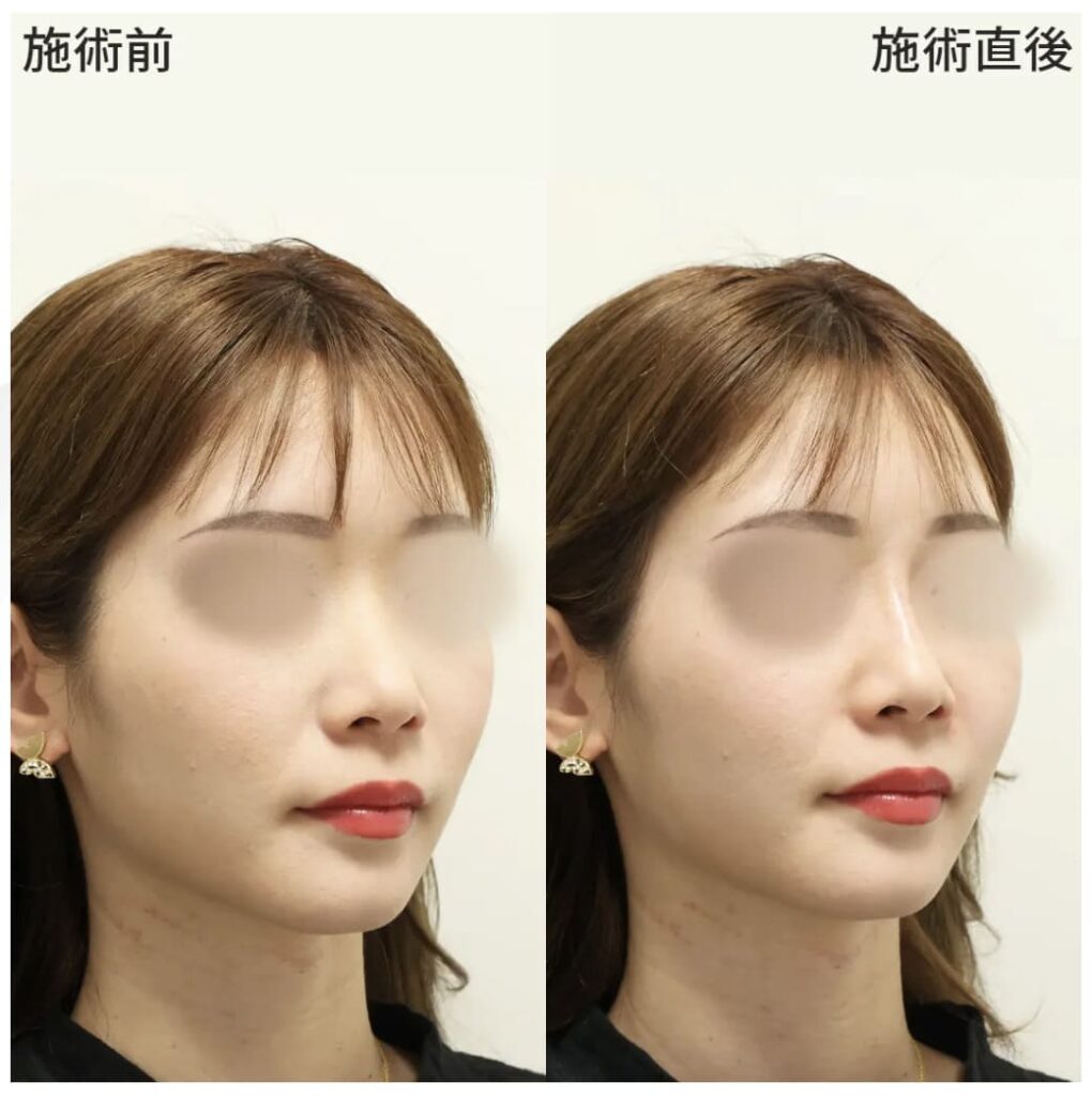 TAクリニックの鼻のヒアルロン酸注入を実際に受けた方の症例画像（ビフォーアフター）