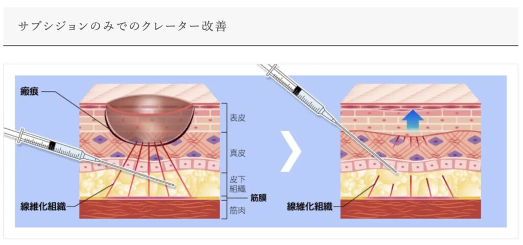 TCB東京中央美容外科のサブジションの効果と改善できるニキビの種類