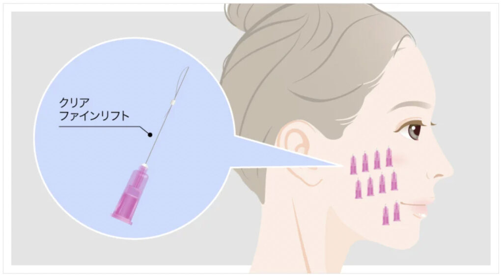 TCB東京美容外科のクリアファインリフトの効果と改善される症状