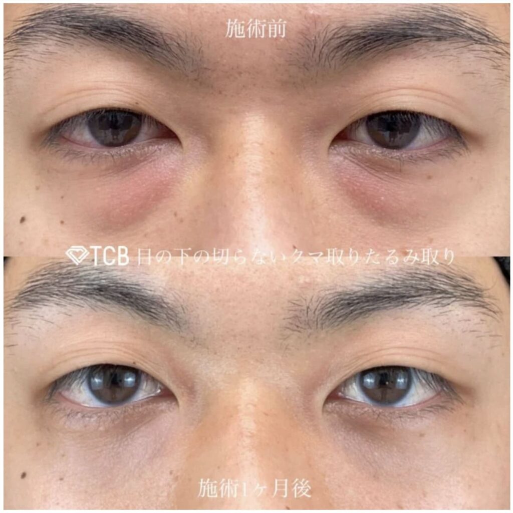 TCB東京中央美容外科の目の下の切らないクマ取りを受けた男性の症例画像（ビフォーアフター）