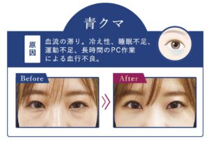 TCB東京中央美容外科の目の下の切らないクマ取りで改善できる青クマ