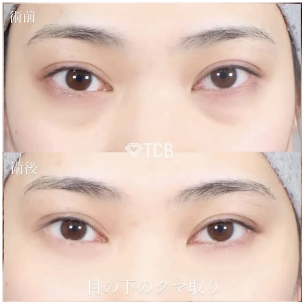 TCB東京中央美容外科の目の下の切らないクマ取りを実際に受けた方の症例画像（ビフォーアフター）