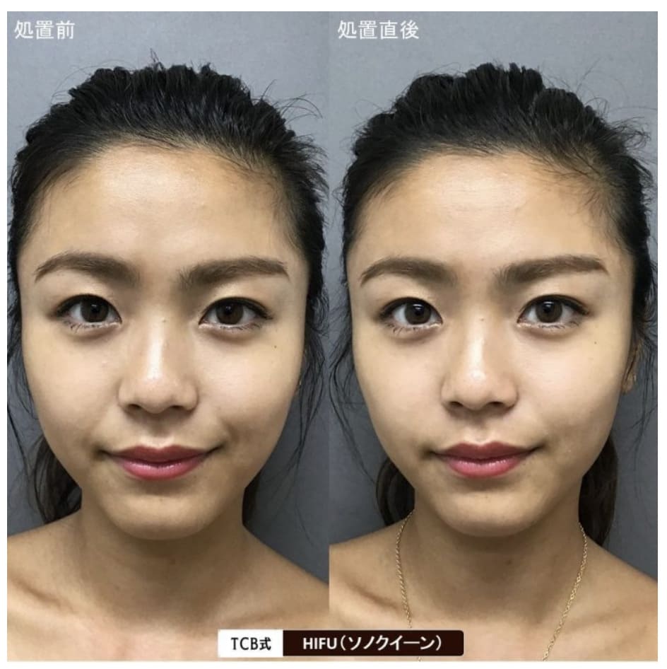 TCB東京中央美容外科のアイリフトHIFUに症例画像（ビフォーアフター）
