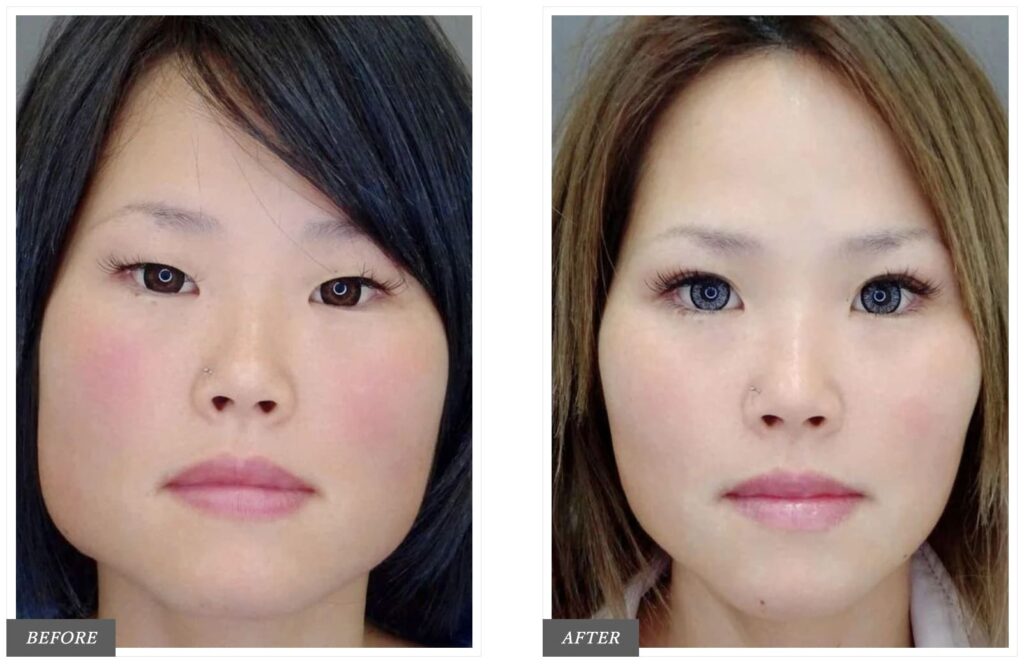 TCB東京中央美容外科のエラボトックスを実際に受けた方の症例画像