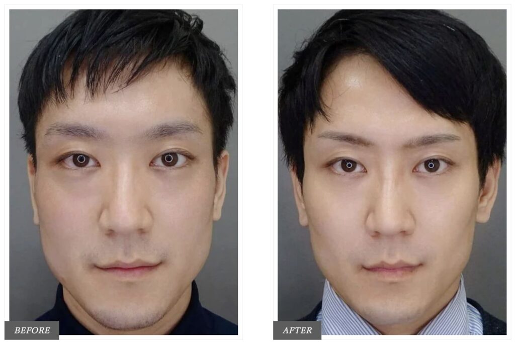 TCB名古屋中央美容外科の口角ボトックスを実際に受けた方の症例画像（男性）