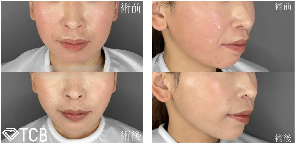 TCB東京美容外科の小顔リフトの症例画像（ビフォーアフター）