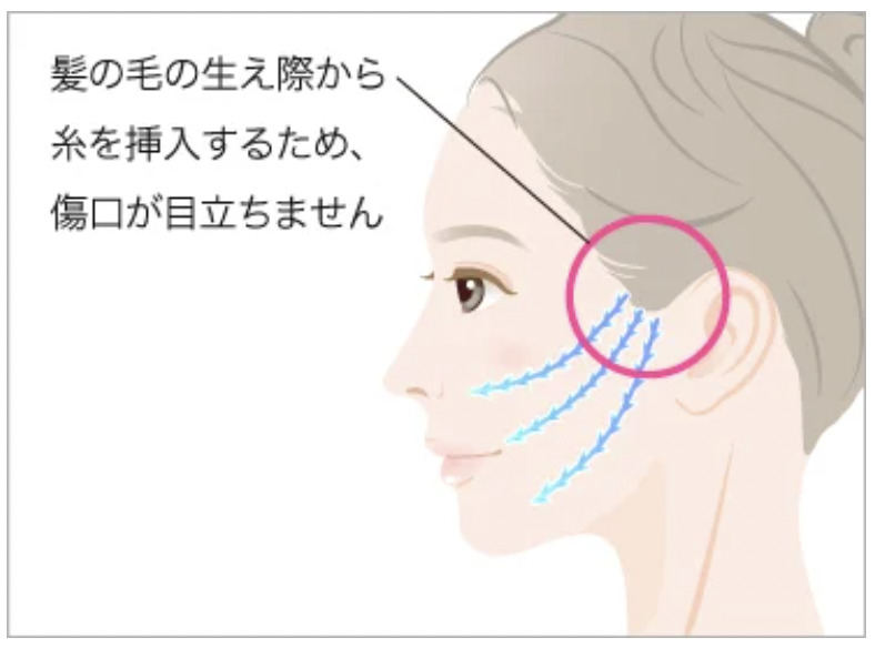 TCB東京美容外科の小顔美肌再生糸リフトの効果と改善できる症状