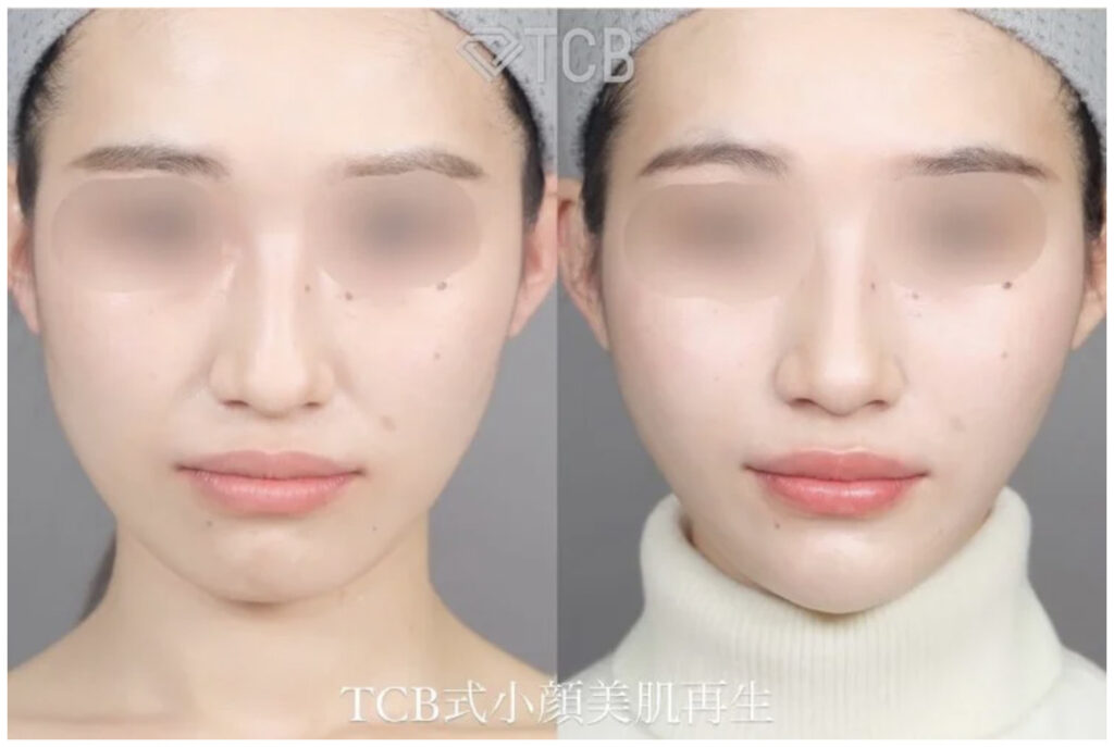 TCB東京美容外科の小顔美肌再生糸リフトの症例画像（ビフォーアフター）