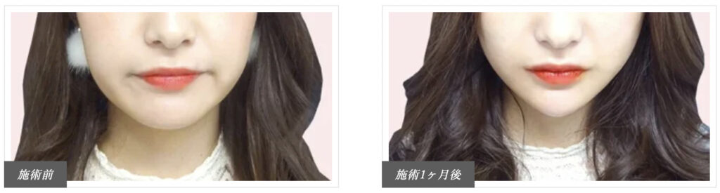 TCB東京美容外科の小顔美肌再生糸リフトの症例画像（ビフォーアフター）