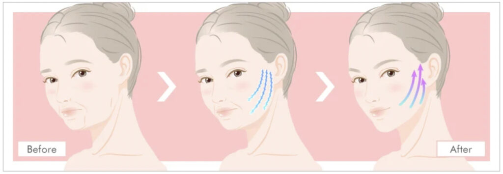 TCB東京美容外科の糸リフトで期待できる効果や改善される症状