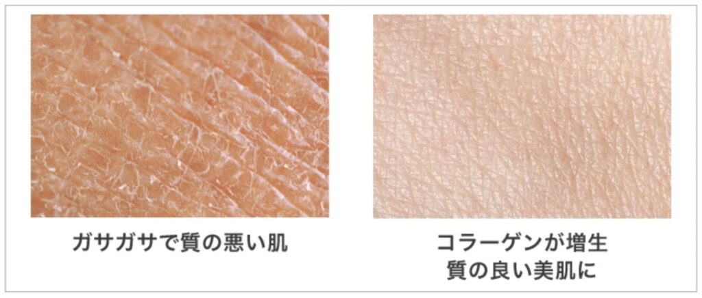 TCB東京美容外科の糸リフトで得られる美肌効果