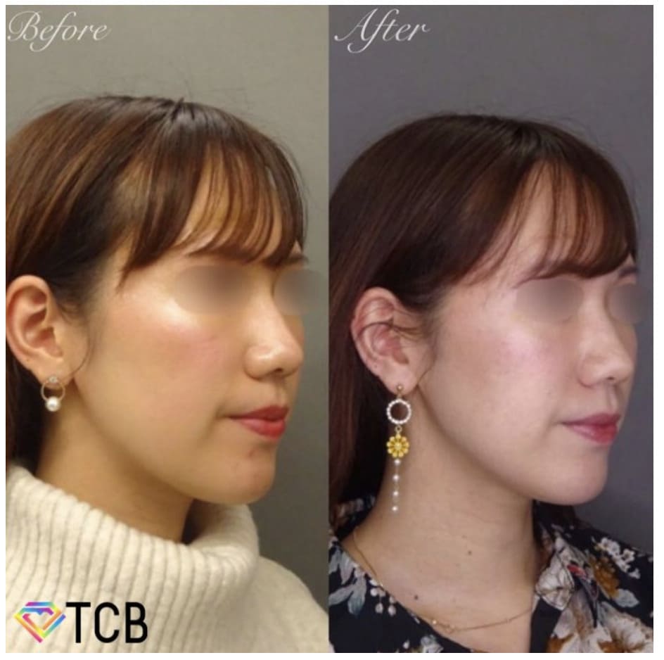 TCB東京中央美容外科の医療ハイフを実際に受けた方の症例画像（ビフォーアフター）