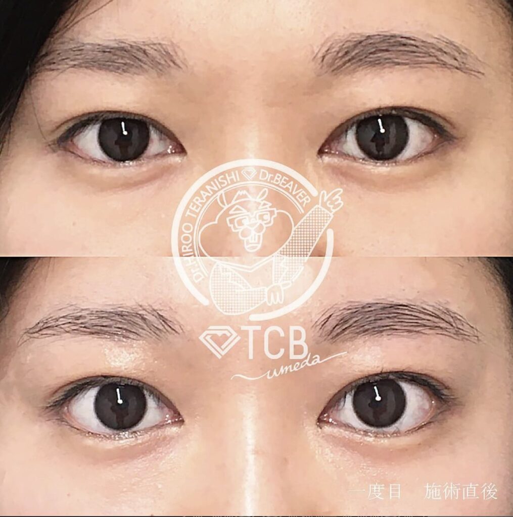 TCB東京中央美容外科のセレネハイフの仕組みと効目周りアイリフトを実際に受けた方の症例（ビフォーアフター）