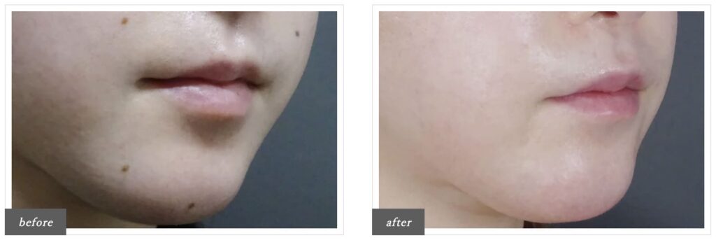 TCB東京美容外科でほくろ除去を実際に受けた方の症例画像（ビフォーアフター）