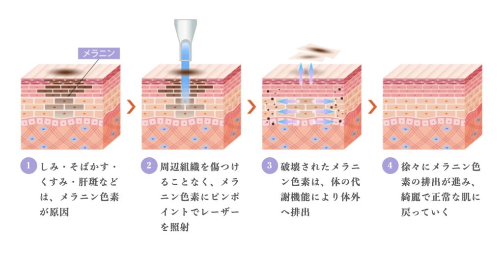 TCB東京中央美容外科のピコレーザーによるシミ取り治療の効果と施術経過
