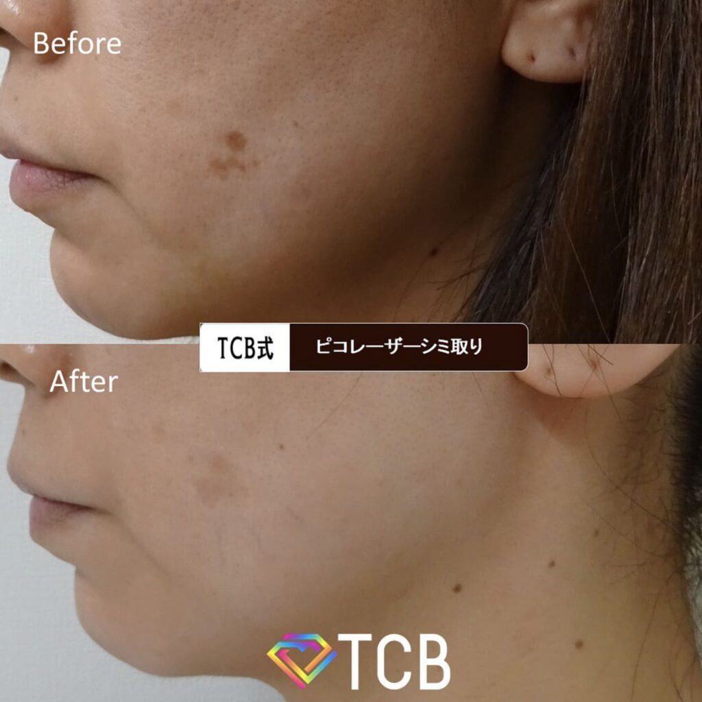 TCB東京中央美容外科でシミ取りを実際に受けた人の症例画像（ビフォーアフター）