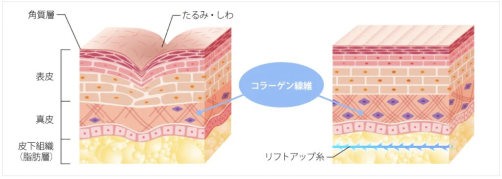 TCB東京美容外科の糸リフトがどのように作用するか