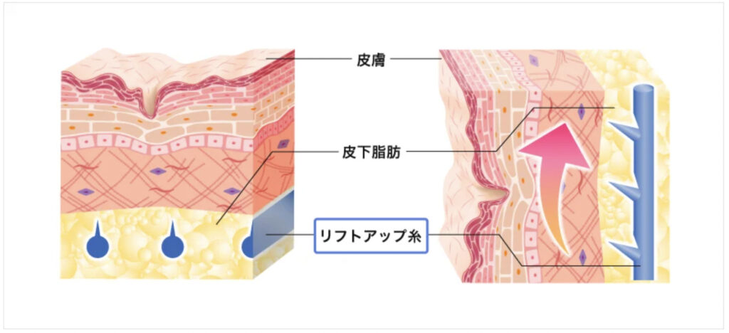 TCB東京美容外科の糸リフトで期待できる効果