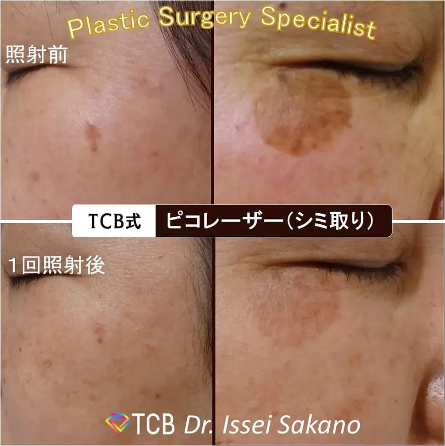 東京中央美容外科（TCB）のシミ取りの症例画像（ビフォーアフター）
