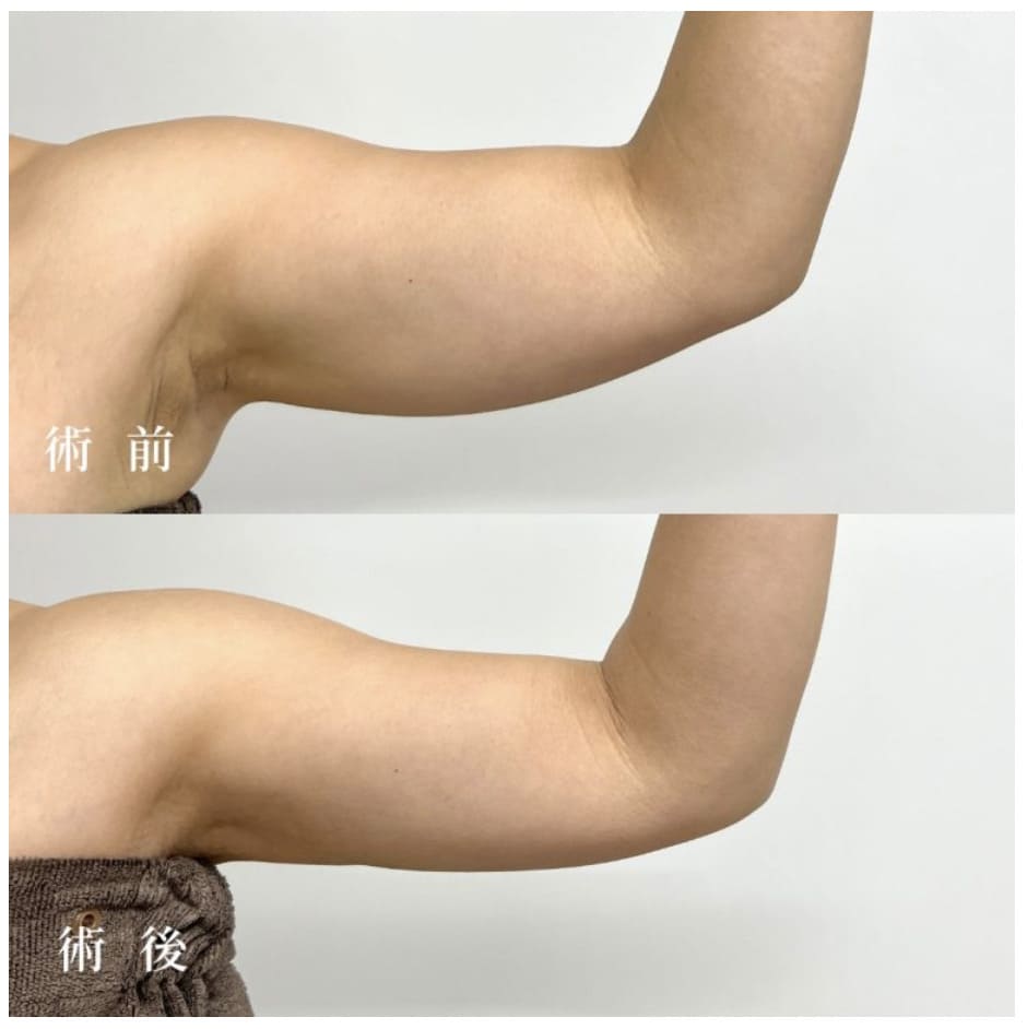TCB東京中央美容外科で二の腕の脂肪吸引を行なった肩の症例画像（ビフォーアフター）