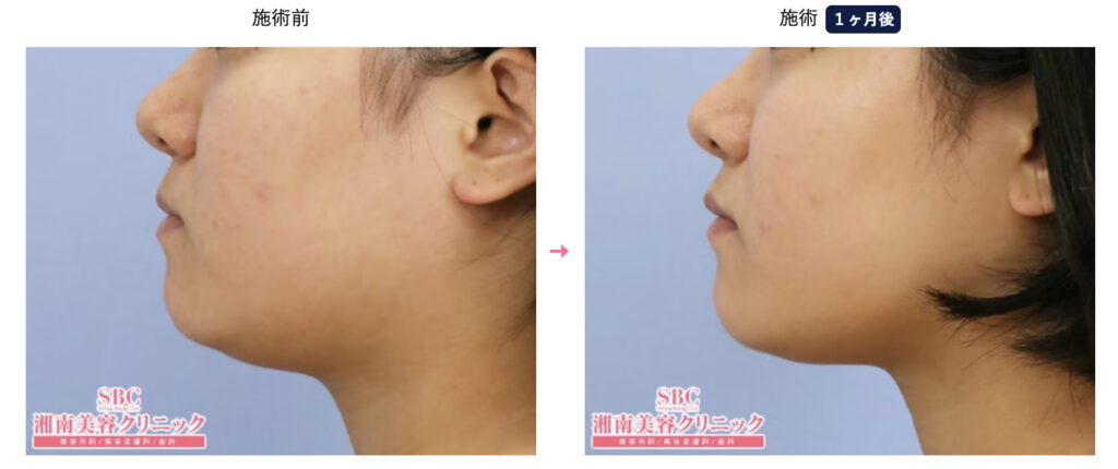 湘南美容外科のメディカルサイズダウン、BNLS注射を実際に受けた方の症例画像（顔のビフォーアフター）