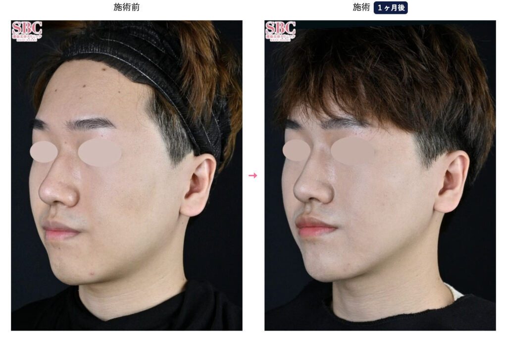 湘南美容外科のメディカルサイズダウン、山参注射を実際に受けた男性の症例画像（ビフォーアフター）