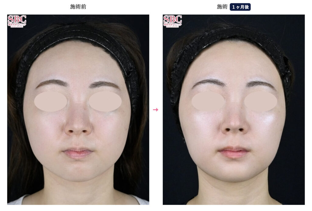 湘南美容外科のメディカルサイズダウン、山参注射を実際に受けた方の症例画像（顔のビフォーアフター）