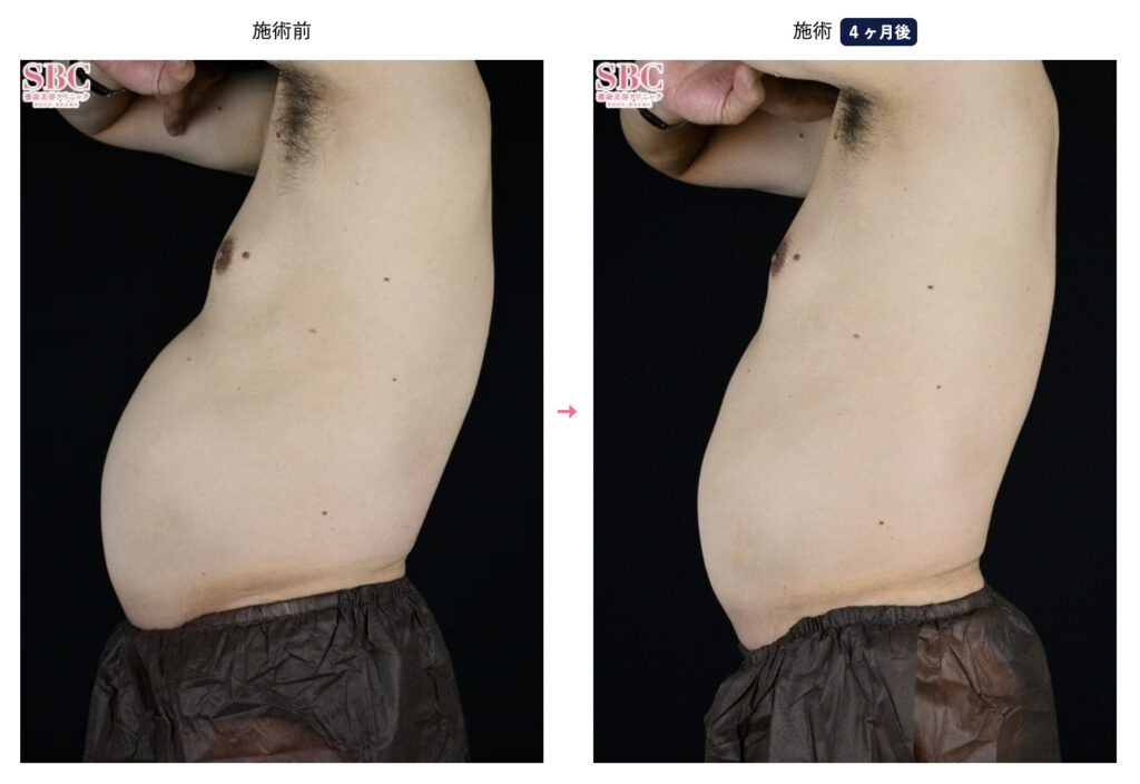 湘南美容外科のメディカルサイズダウン、山参注射を実際に受けた男性の症例画像（ビフォーアフター）