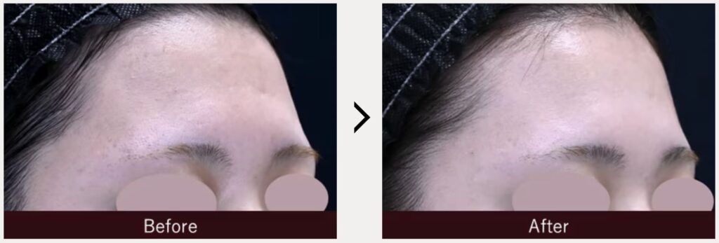 湘南美容外科のヴェルベットスキンを実際に受けた方の症例画像（ビフォーアフター）