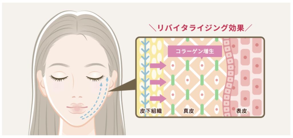 品川美容外科の糸リフト「美肌アモーレ」で得られる効果