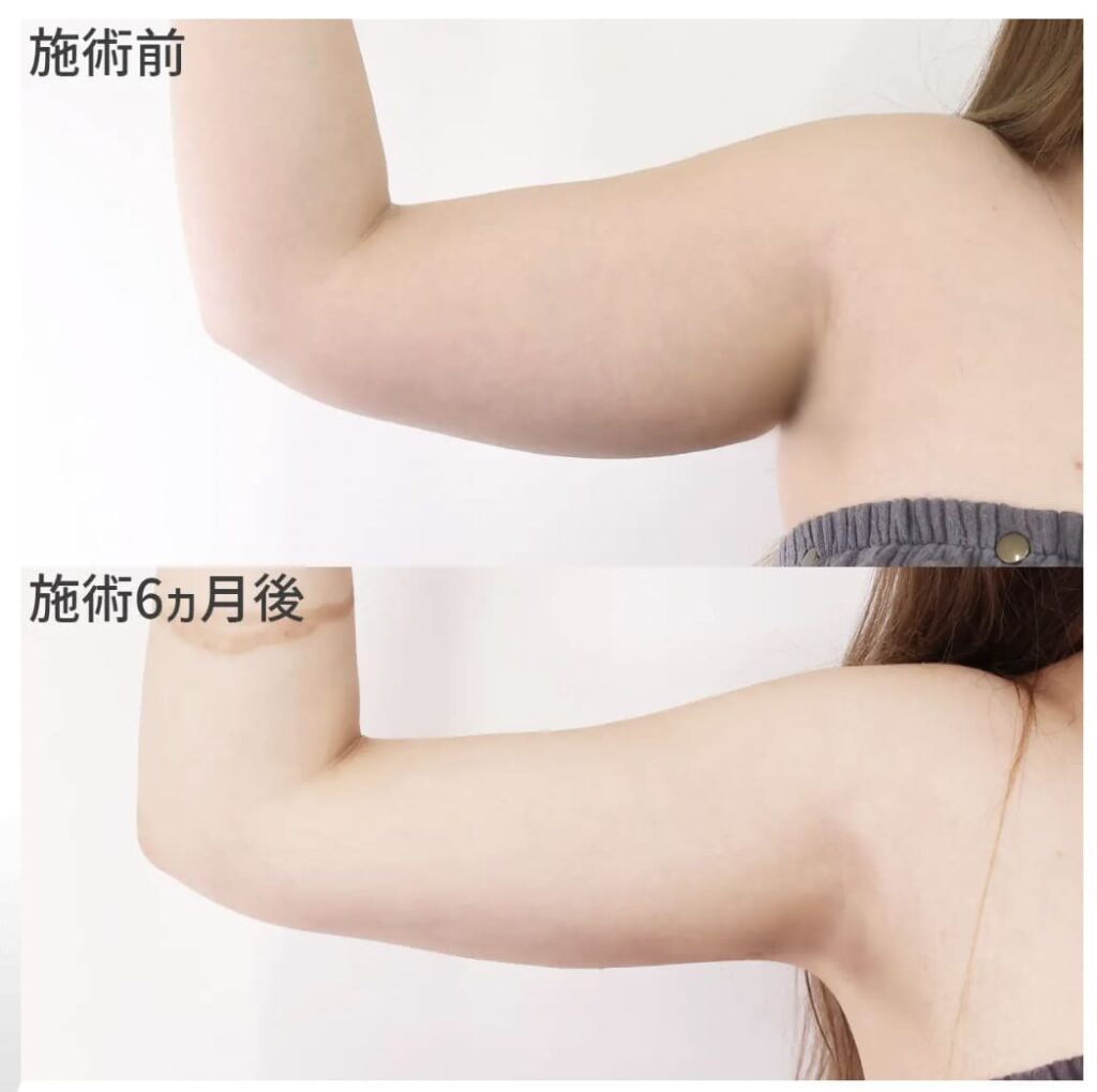 TAクリニックで二の腕の脂肪吸引を行なった肩の症例画像（ビフォーアフター）