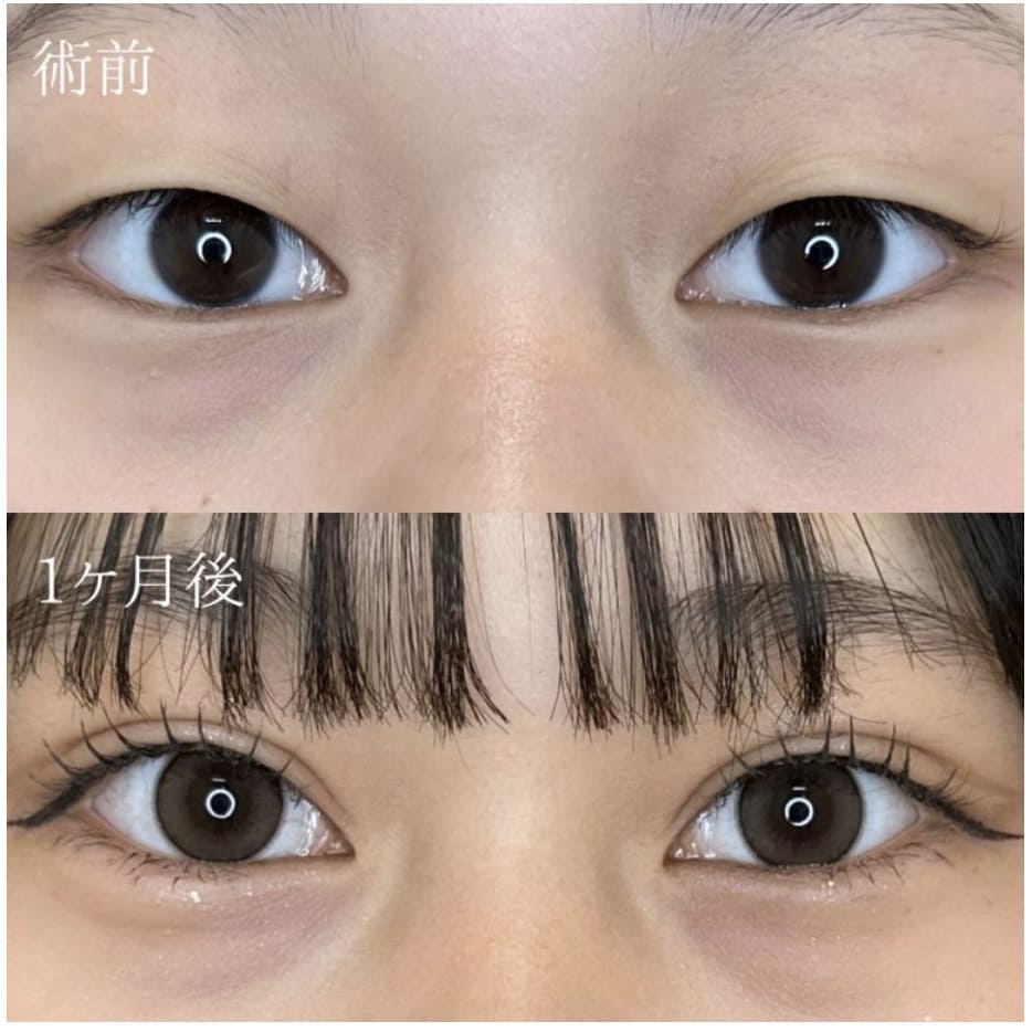 TCB東京中央美容外科の青春二重術を実際に受けた方の症例画像（ビフォーアフター）