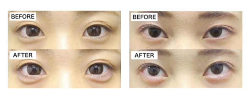 TCB東京中央美容外科で涙袋形成を実際に受けた方の症例画像（ビフォーアフター）