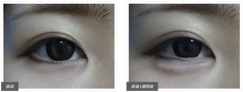 TCB東京中央美容外科で涙袋形成を実際に受けた方の症例画像（ビフォーアフター）