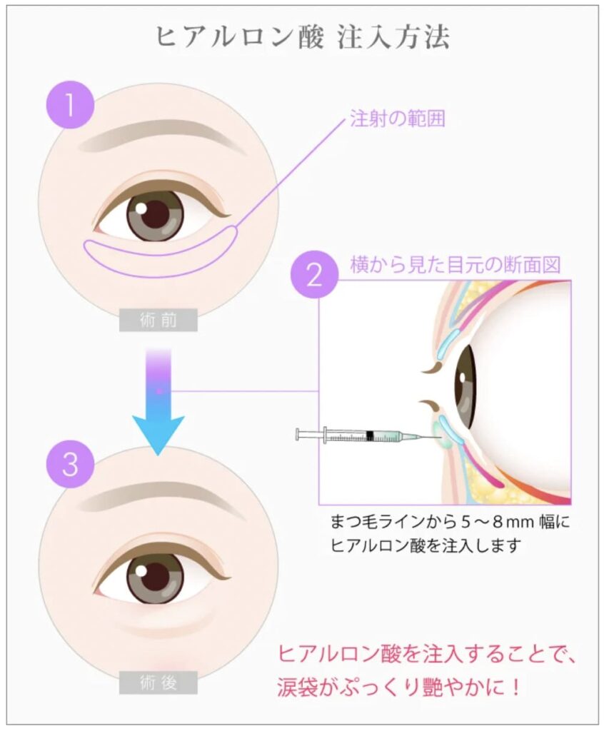 TCB東京中央美容外科の涙袋形成の施術フロー