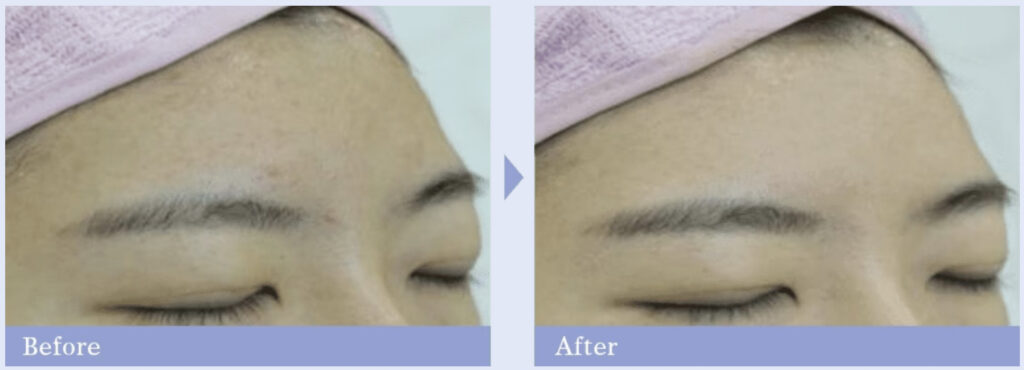 湘南美容外科のハイドロピーリングを実際に受けた方の症例画像（ビフォーアフター）
