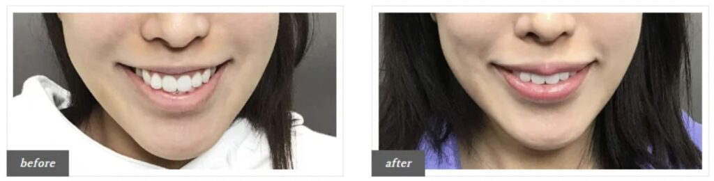 TCB東京中央美容外科のガミースマイル治療を実際に受けた方の症例画像（ビフォーアフター）