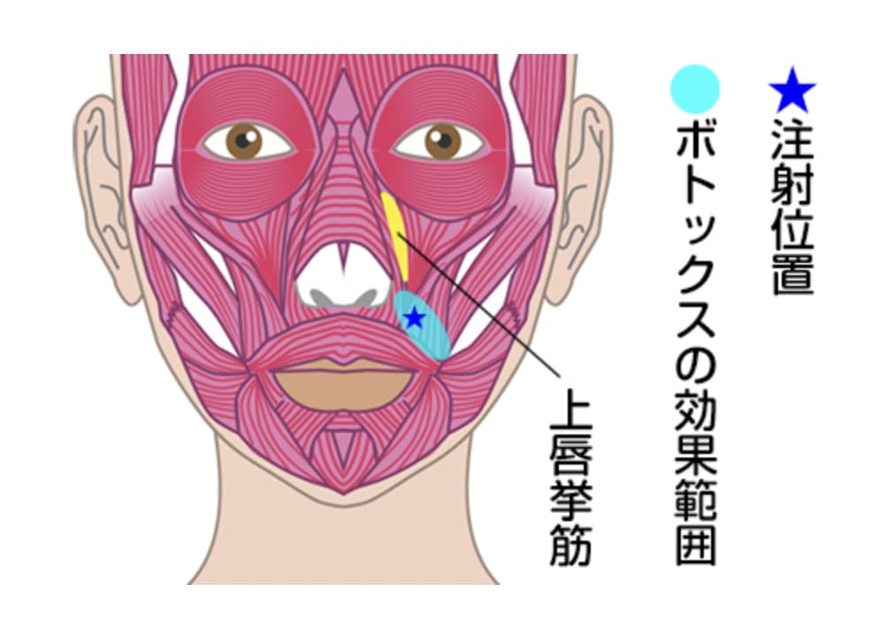 TCB東京中央美容外科のガミースマイル治療でボトックスを注入する箇所（上唇挙筋）